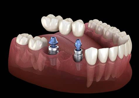 oral-surgery-475x336.jpg